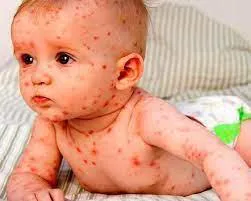 هشدار وزارت بهداشت در خصوص شیوع سرخک
