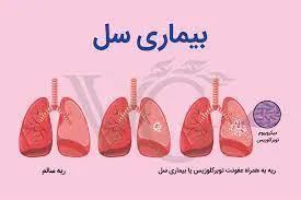 بیماری سل را جدی بگیرید 